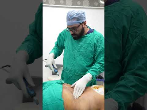 Liposuction | Liposuction cost #shortvideo #shots