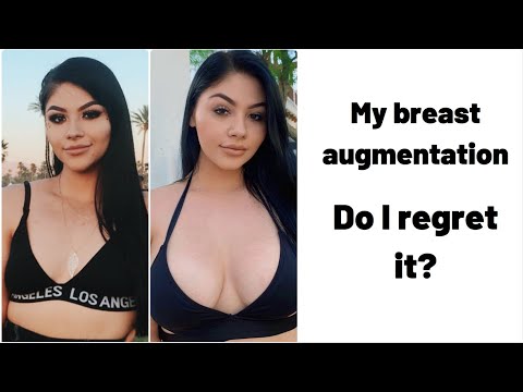 MY BREAST AUGMENTATION EXPERIENCE// HOW IT AFFECTED ME