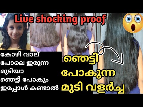 മാസങ്ങൾക്കുള്ളിൽ Shocking Hair Growth||നിങ്ങൾക്കും ഈസി ആയി മുടി വളർത്താം||#hair #growth