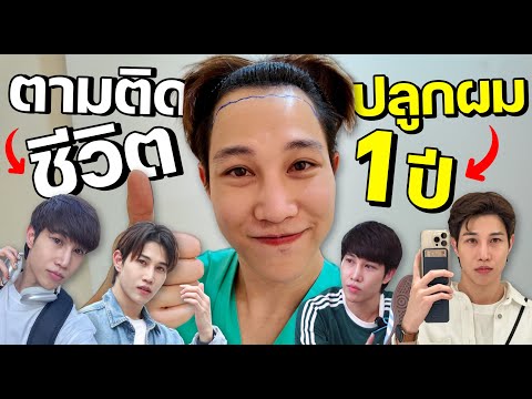 ปลูกผมผู้ชาย ก่อน - ครบ 1 ปี เป็นยังไง มาดู!! | เอามั้ยลองไมค์