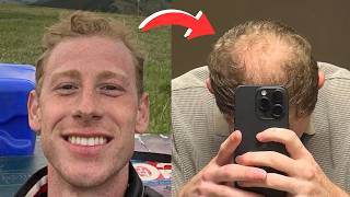 Getting A BUZZ CUT Freed Me From BALDING Insecurity