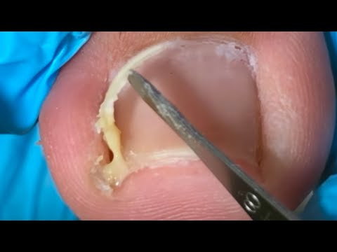 Be Careful When Peeling Off Deeply Inflamed Ingrown Toenails!【Crazy pedicure room】