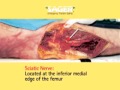 Sager Splint and Femoral Fractures