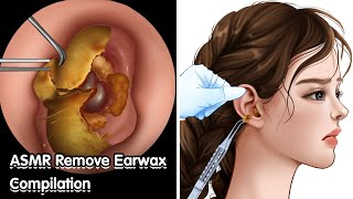 ASMR Remove Earwax Compilation 귀지 제거 컴파일 - Deep Cleaning Treatment