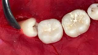 For example, a video showing a tooth extraction
