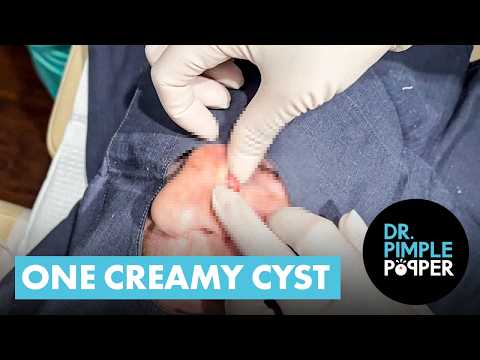 One Creamy Cyst