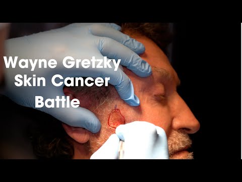 Wayne Gretsky Skin cancer Battle Part 1: Facial Mohs Surgery