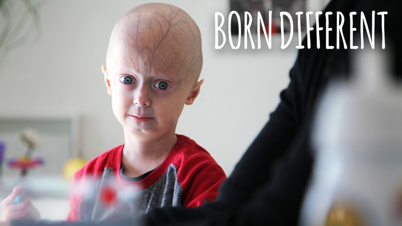 The 6-year-old who's ageing too fast - born different