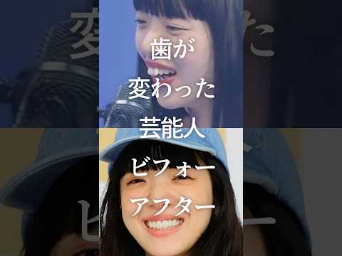 ㊗️100万再生！歯が変わった芸能人ビフォーアフター　#ガルちゃん #芸能人 #歯列矯正