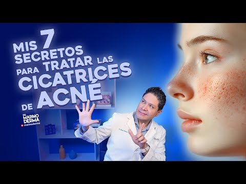 MIS 7 SECRETOS PARA TRATAR LAS CICATRICES DE ACNÉ || Consejos de un dermatólogo