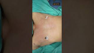 Gynecomastia Surgery