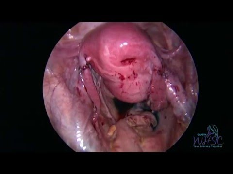 tubal laparoscopic reversal ligation