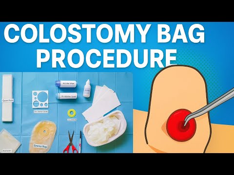 Colostomy Bag कैसे लगाएं? | Step by Step Procedure with Real Tools 🩺 | Stoma Bag