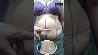 Tummy Tuck Result