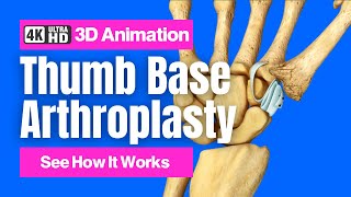 How a Tendon Can Replace an Arthritic Thumb Joint: Thumb Base Arthroplasty