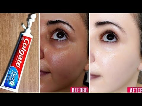 Colgate ये चीज मिलाकर लगाया चेहरे का कालापन दाग धब्बे  5मिनट में गायब हो गए | Remove Dark Spots