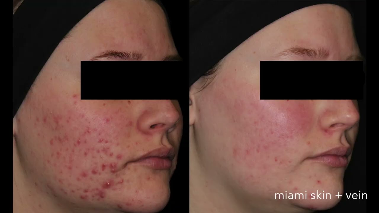 Acne treatment results before and after comparison.