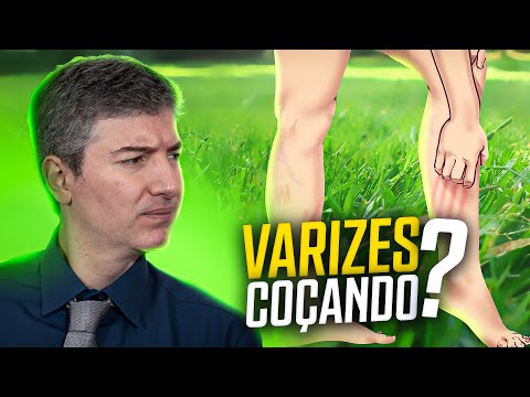 Varizes Coçam? Descubra os Riscos Ocultos e Como Evitá-los