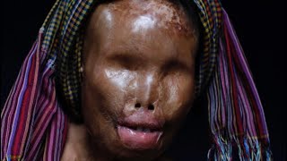 The HORRIFYING History of Acid Attacks
