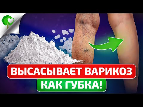 Оказывается, варикоз реально лечится — просто и дома!
