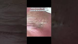 You know the sun causes wrinkles. But blackheads? ☀️👀