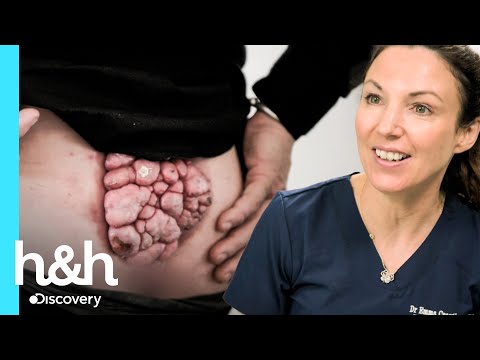 Paciente tem um caroço na região lombar há 8 anos | Dra. Emma: Uma Questão de Pele | H&H Brasil