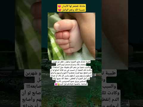 طفل ذو شهرين ونصف، بُكاء وصراخ مُستمر ليوم كامل والسبب شعرة من شعر الأُم ملفوفة حول أصابعه كادت تبتر