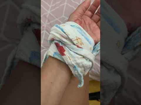 QUIERES VER ó NO? ? comenta y te ENSEÑO LA ?HERIDA en LOS COMENTARIOS?