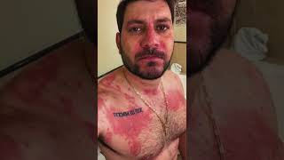 ASSUSTADOR! Ex-BBB vai parar no hospital após crise alérgica!