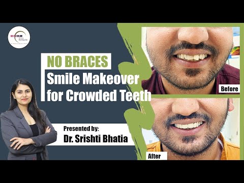 No Braces Smile Makeover for Crooked Teeth: Dr. Srishti Bhatia #smile #smilemakeover