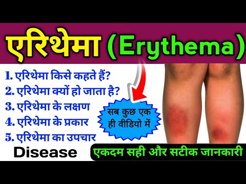 एरिथेमा रोग (erythema disease) | एरिथेमा के कारण, लक्षण, प्रकार, उपचार | erythema rog ke lakshan