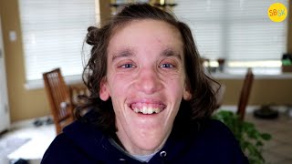Living with a Disconnected Brain and Chromosome Mutation