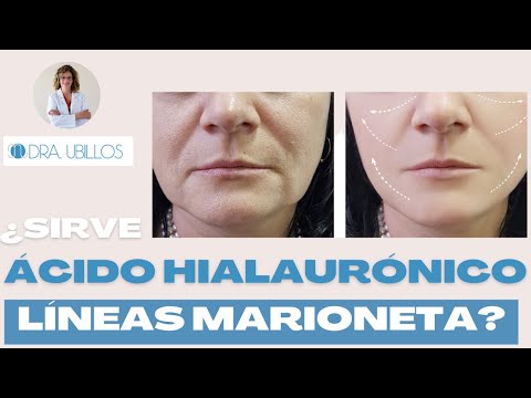 ¿ES EFICAZ EL ÁCIDO HIALURÓNICO PARA LAS LÍNEAS DE MARIONETA?