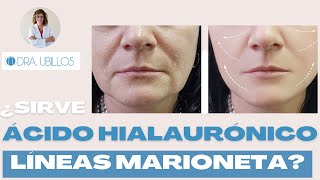 ¿ES EFICAZ EL ÁCIDO HIALURÓNICO PARA LAS LÍNEAS DE MARIONETA?