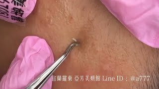 202506145白頭粉刺whiteheads--Taiwan Yilan City-宜蘭清粉刺達人-亞芳美妍館