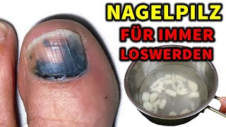 Tun Sie dies 3 mal pro Woche, um Nagelpilz schnell loszuwerden