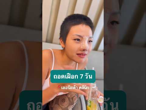 ในความบวมช้ำคะน้องพิซซ่า?￼ ถอดเฝือกแทบไม่ช้ำเลย #lenistaclinic #เลอนิสต้าคลินิก #เสริมจมูก #พิซซ่า