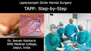 Laparoscopic Inguinal Hernia Surgery TAPP