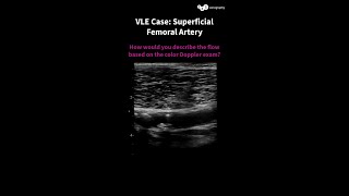 B-mode and color Doppler examination of the superficial femoral artery🦵