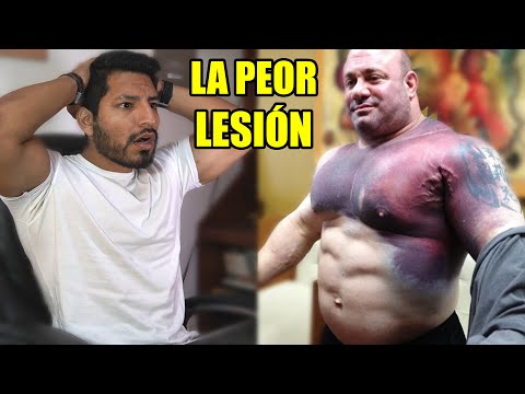 LA PEOR LESIÓN EN EL GIMNASIO - Hombre se Rompe el Pectoral Entrenando