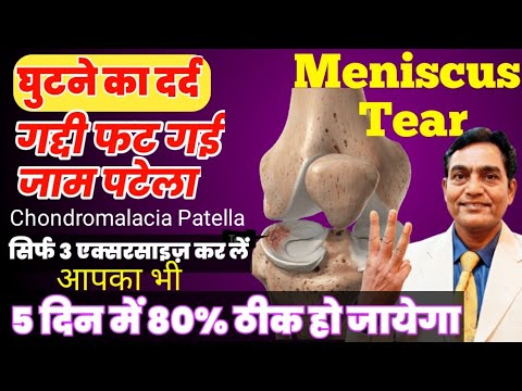 घुटने का गद्दी फट गयी Meniscus Tear Grade 3 Exercises | Chondromalacia Patella Physiotherapy Hindi