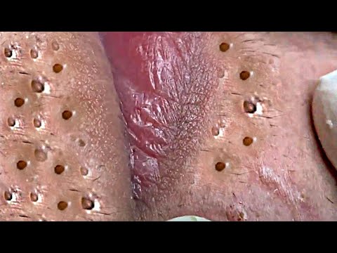 Big Cystic Acne Blackheads Extraction Blackheads & Milia, Whiteheads Removal Pimple Popping # 8401