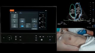 How-to Video: Assisted Cardiac Output Calculation with Sonosite LX and Sonosite PX