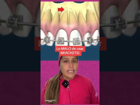 Al usar #brackets o #alineadores para corregir una sonrisa existe un acortamiento de las #raices