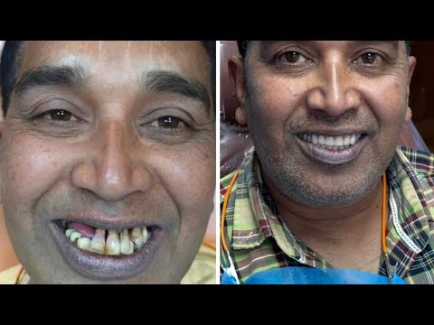 60 घंटो मे ज़िन्दगी बदल गयी 😀 ! Full Mouth Dental Implant with Fix Teeth within 3 Days !