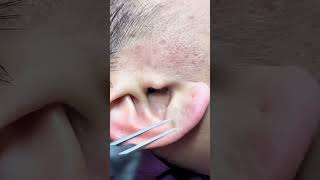 耳朵黑頭清除實錄｜四個毛孔竟然相通！Blackheads in the Ear – 4 Connected Pores!