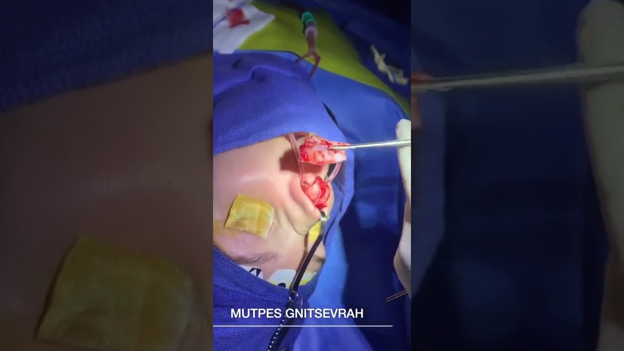 Surgical procedure involving oral tissue extraction.