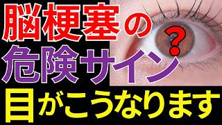 【医師監修】見逃すと危険な「脳梗塞が近い人だけに起こる目の異変」