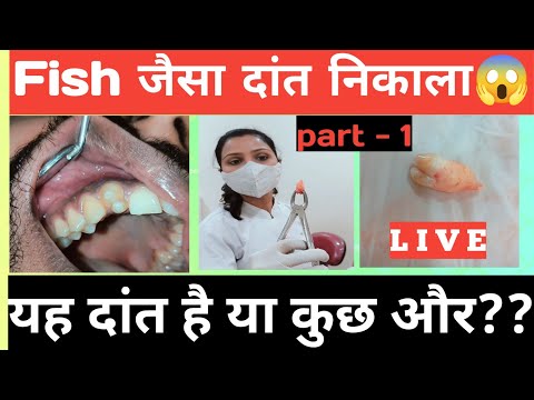 यह दांत है या कुछ और|Fish Shape Tooth Removal Live On Patient 😱 |Dant Ka Dard |Cost Of Tooth Removal