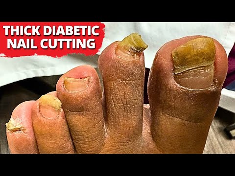 Extreme THICK Toenail Cutting on Diabetic Patient 😳 | So Satisfying!